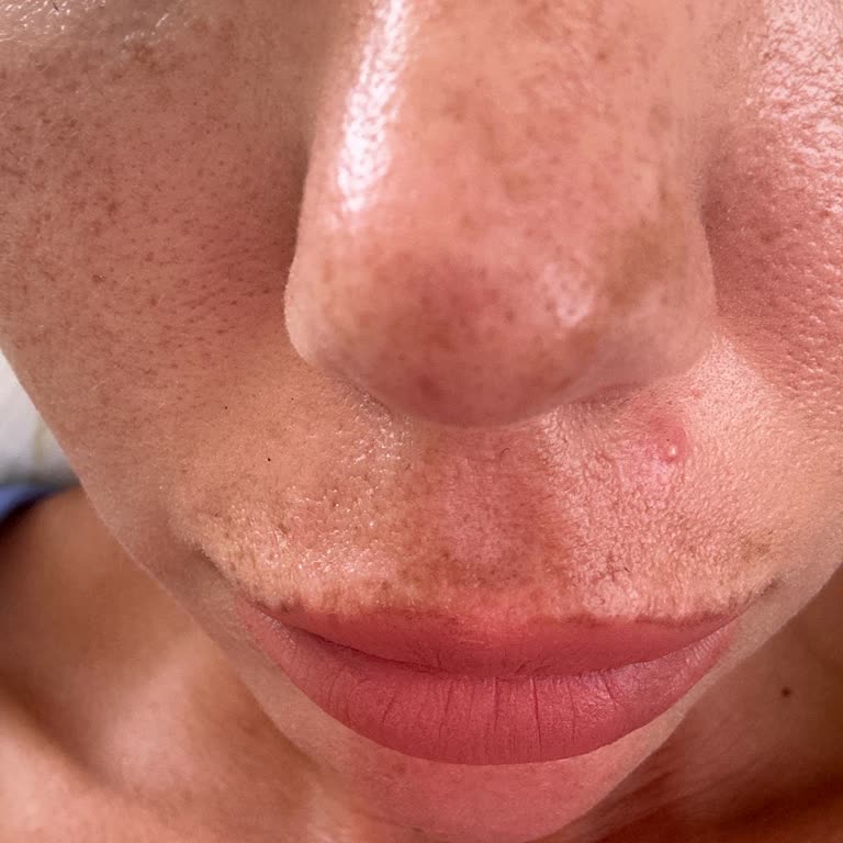 British Esthetic Mezoterapi İşlemi Mağduriyet