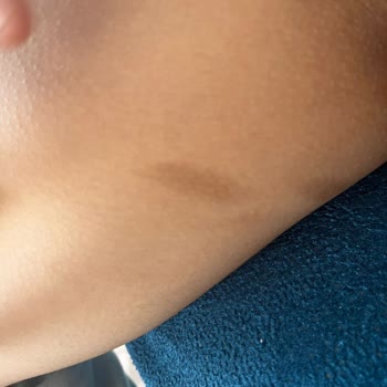 UniQue Epilasyon ve Güzellik Lazer İşleminde Yaktılar