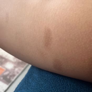 UniQue Epilasyon ve Güzellik Lazer İşleminde Yaktılar