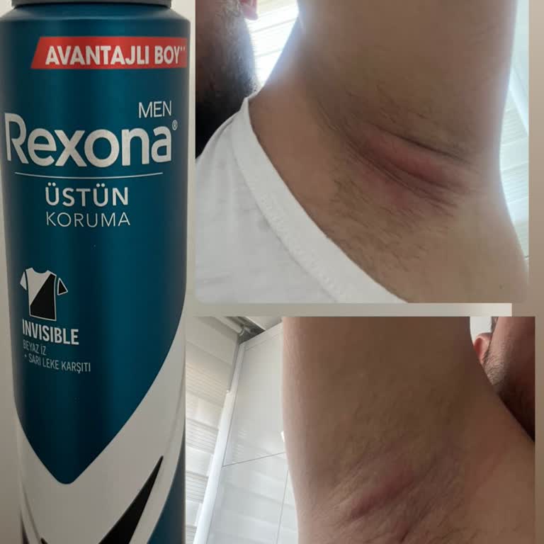 Rexona Koltuk Altımın Enfeksiyon Kapmasına Sebep Oldu!