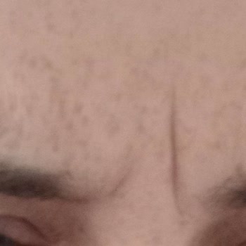 Estemore Güzellik Merkezi Botoks Uygulaması Sorunu