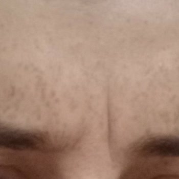 Estemore Güzellik Merkezi Botoks Uygulaması Sorunu