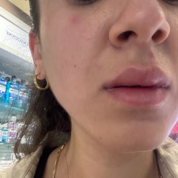 La Roche - Posay Eczaneden Aldığım Güneş Koruyucu Yüzümü Mahvetti