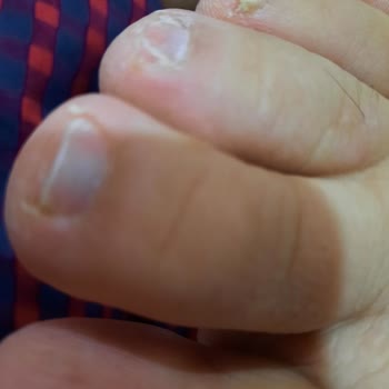 Özel Optimed Hastanesi Ayak Mantarı Tedavisinde Yaşanan Sorunlar