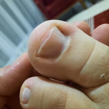 Özel Optimed Hastanesi Ayak Mantarı Tedavisinde Yaşanan Sorunlar