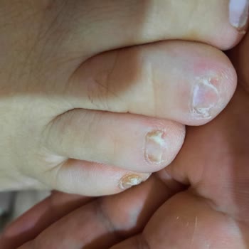 Özel Optimed Hastanesi Ayak Mantarı Tedavisinde Yaşanan Sorunlar