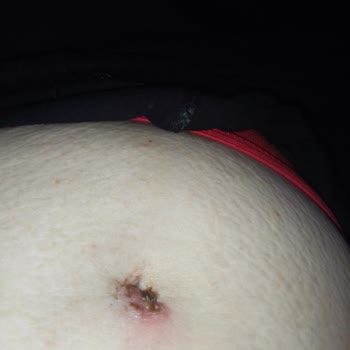 Kahramanmaraş Sütçü İmam Üniversitesi Hayali Pansuman Beni Tedavi Etmediler