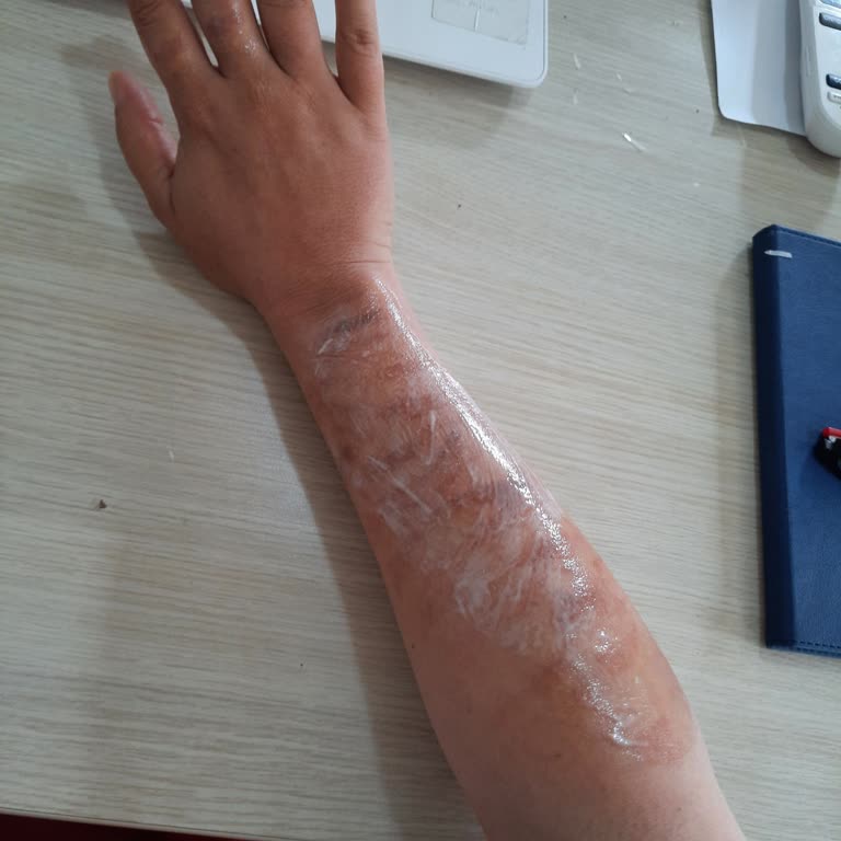 His Beauty Güzellik Merkezi Buz Lazer Yanığı