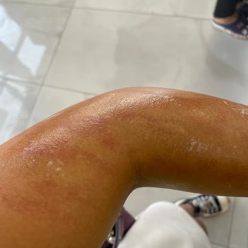 Aden Beauty Estetik ve Güzellik Merkezi Aden Beauty Lazer Yanığı