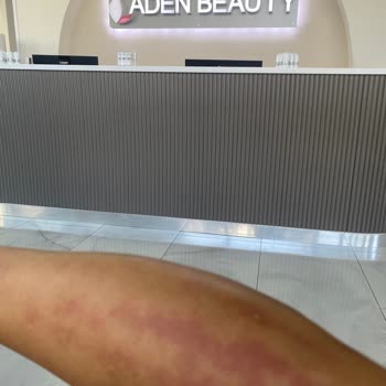 Aden Beauty Estetik ve Güzellik Merkezi Aden Beauty Lazer Yanığı