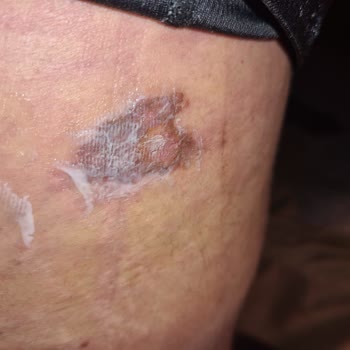 Doç. Dr. Yahya Baltu Liposuction Sırasında Vücudu Yakması