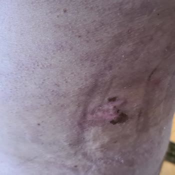 Doç. Dr. Yahya Baltu Liposuction Sırasında Vücudu Yakması