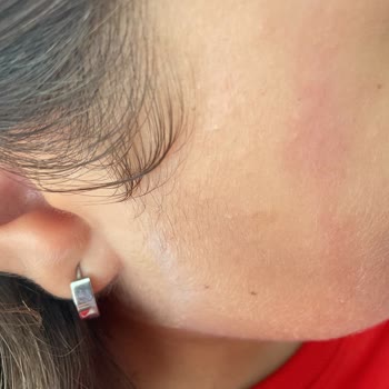 Claderm Kil Maskesi Kullanımı Sonrası Ciltte Kızarıklık Problemi