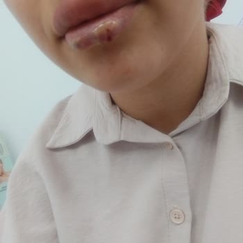 Kadıköy Clinical Yanlış Dudak Dolgusu Steril Olmayan İşlem