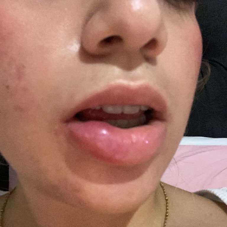 Essence Alerji Dudak Şişmesi