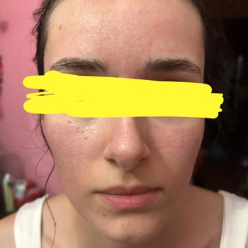 Rossmann'dan Aldığım Isana Maske Yüzümü Yaktı