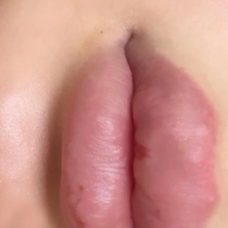 Kosmetolog_lalita Dudak Dolgusu İşleminde Memnuniyetsizlik Ve İlgisizlik