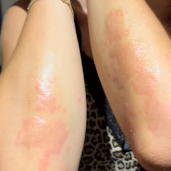 Jolly Tur Hastalık Nedeniyle Erken Ayrılmada İade Sorunu