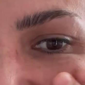 AZT Clinic (Ataşehir) Azt Clinic Yanlış Yaptığı Botoks Ve Gençlik Aşısı Sonucu