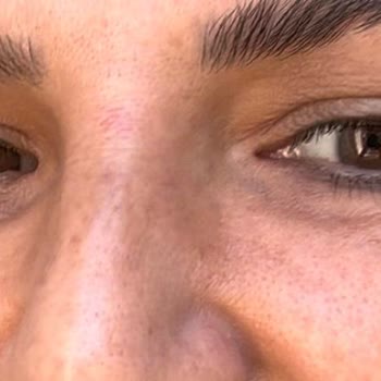 AZT Clinic (Ataşehir) Azt Clinic Yanlış Yaptığı Botoks Ve Gençlik Aşısı Sonucu
