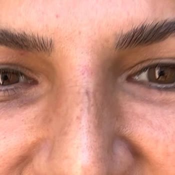 AZT Clinic (Ataşehir) Azt Clinic Yanlış Yaptığı Botoks Ve Gençlik Aşısı Sonucu