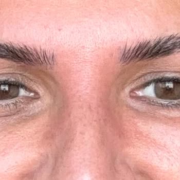 AZT Clinic (Ataşehir) Azt Clinic Yanlış Yaptığı Botoks Ve Gençlik Aşısı Sonucu