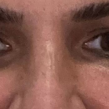 AZT Clinic (Ataşehir) Azt Clinic Yanlış Yaptığı Botoks Ve Gençlik Aşısı Sonucu