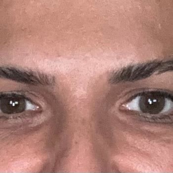 AZT Clinic (Ataşehir) Azt Clinic Yanlış Yaptığı Botoks Ve Gençlik Aşısı Sonucu