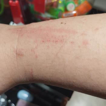 Watsons Tüy Dökücü Sprey Kolumda Kabarcık Ve Kaşıntıya Neden Oldu!