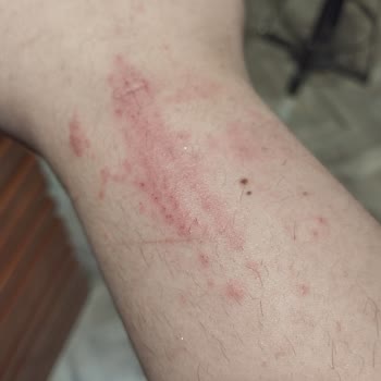 Watsons Tüy Dökücü Sprey Kolumda Kabarcık Ve Kaşıntıya Neden Oldu!