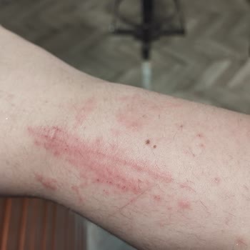 Watsons Tüy Dökücü Sprey Kolumda Kabarcık Ve Kaşıntıya Neden Oldu!