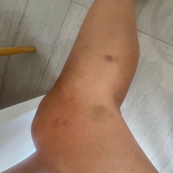 Hotel Samara 5 Yıldızlı Otelde Kadına Şiddet Ve Buna Duyarsız Kalan Otel Yetkililer