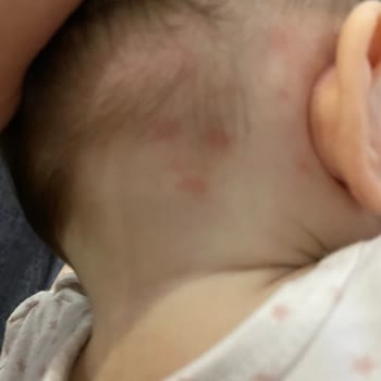 Sma Mama Bebeğimin Ağız Kenarlarını Kızartıyor