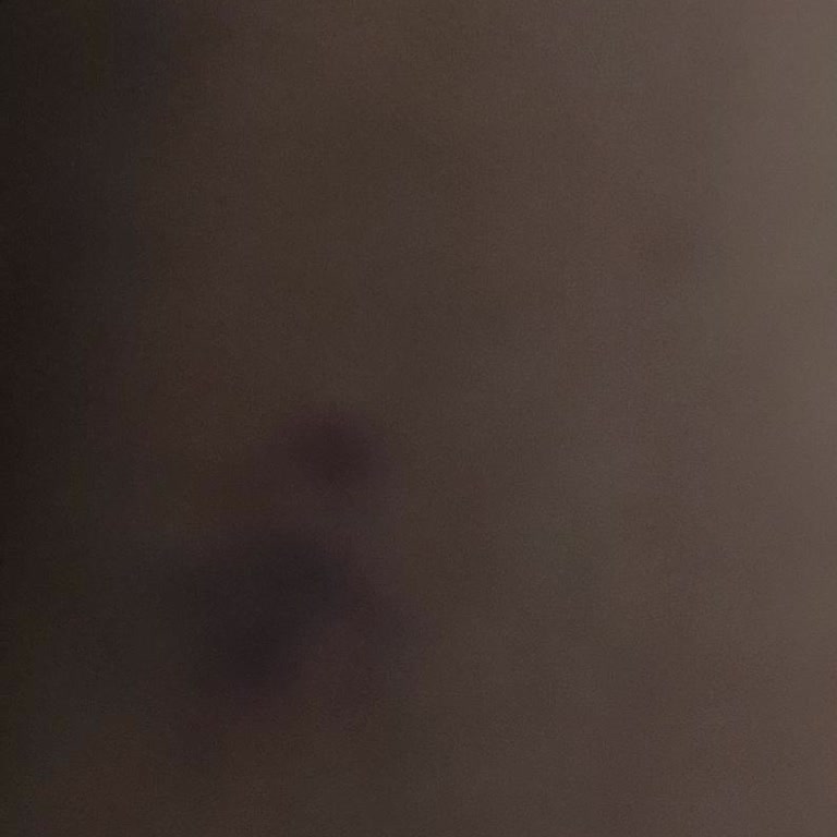 Novar Poliklinik Lazere Gidiyorum Vücudumu Yaktılar