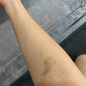 Altınkoza Hastanesi Serum Taktırma Sonrası Damar Problemi