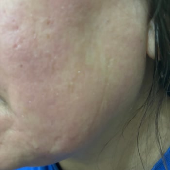 Eyüp Sabri Tuncer Ciltte Tahriş Ve Kızarıklık Yapan Ürün