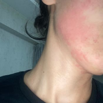 Watsons Maske Alerji Yaptı