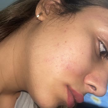 Enza Güzellik Merkezleri Lazer Epilasyon Sonrası Artan Kıl Problemi Ve İlgisiz Hizmet