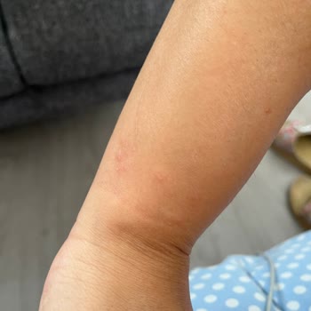 Atelier Duygu 3MM Su Yolu Bileklik Alerji Yaptı