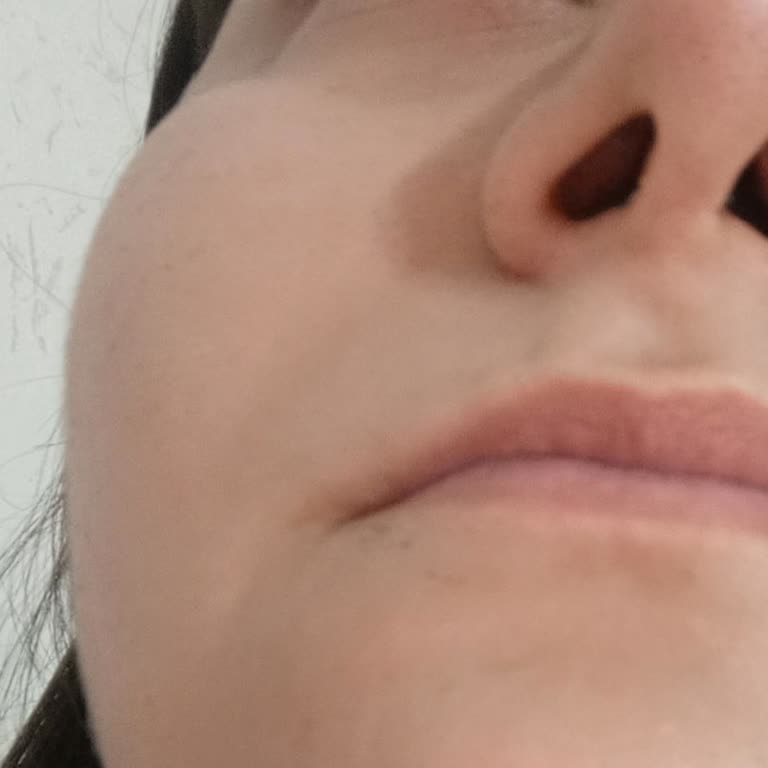 Op. Dr. Fatih Dağdelen Burun Ameliyatı Oldum Burnum Cadı Gibi Uzatıldı Ve Eğri!