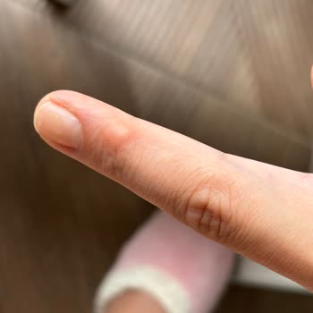 Dyson Dayson V8 Kullanımında Parmağımda Nasır Oluştu