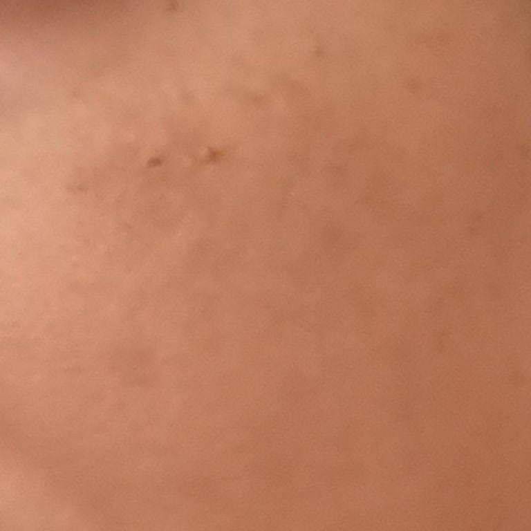 Dr. Fulya Tezel Dermatoloji Leke Tedavisi Hakkında Tarafsız Değerlendirme