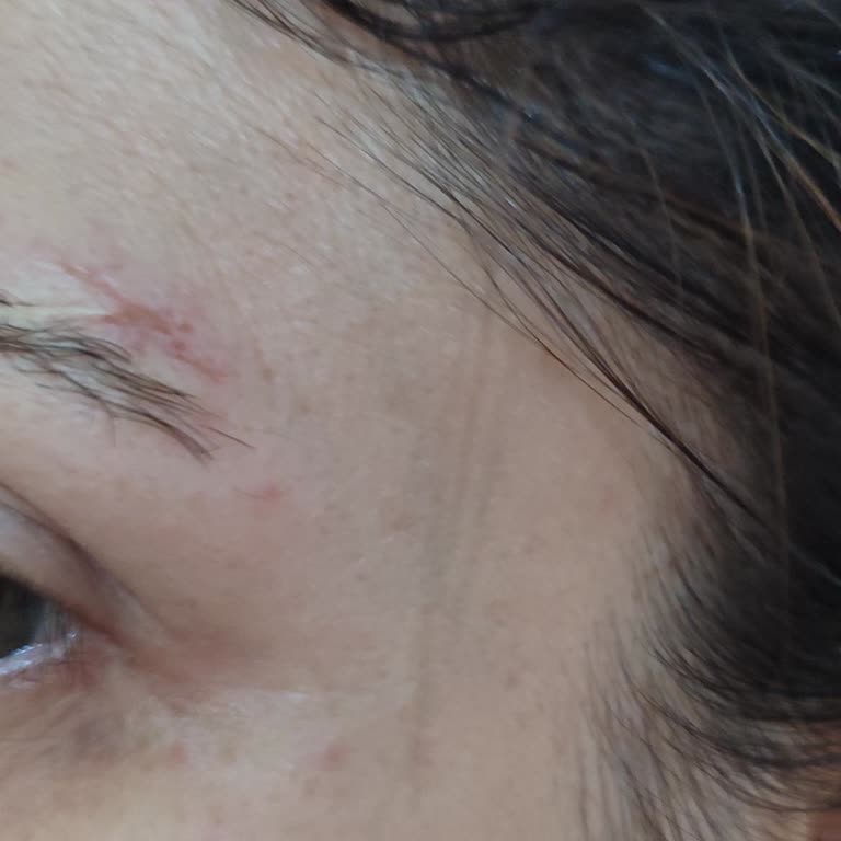 Bahar Acar Güzellik Merkezi Kaş Laminasyonu Sonrası Tahriş Ve Memnuniyetsizlik