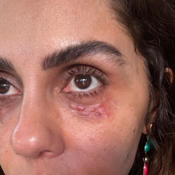 Dr. Healing Güzellik Merkezi Antalya Da Dr. Healing Merkezinde Yapılan Gözaltı Mezoterapisi Sonucu