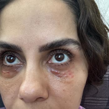 Dr. Healing Güzellik Merkezi Antalya Da Dr. Healing Merkezinde Yapılan Gözaltı Mezoterapisi Sonucu