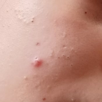 Bioderma Sebium Toniği Yüzümde Sivilce Yaptı