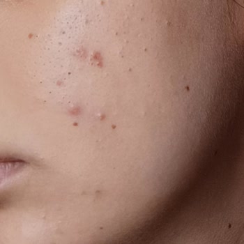 Bioderma Sebium Toniği Yüzümde Sivilce Yaptı