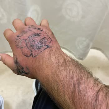 Çiğdem Gülbeyaz Beauty Lazer İşlemi Sırasında Yaşanan Sorunlar