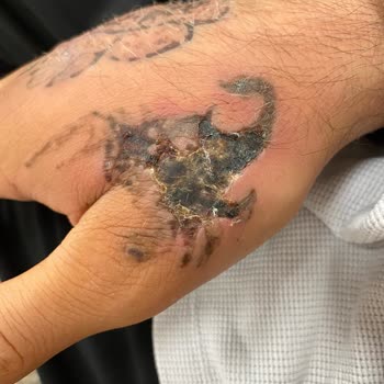 Çiğdem Gülbeyaz Beauty Lazer İşlemi Sırasında Yaşanan Sorunlar