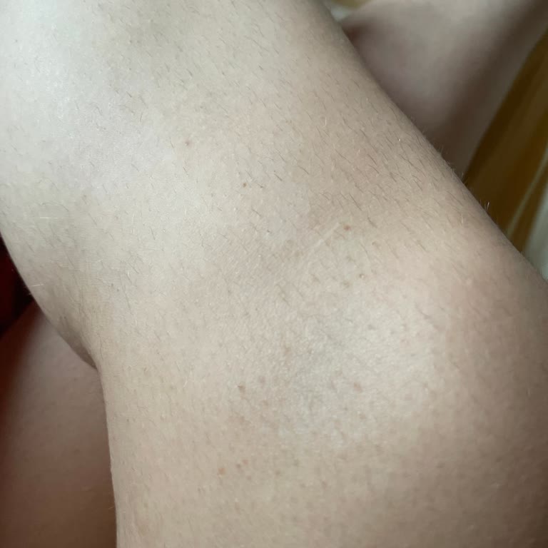 Aytume Beauty Lazer Epilasyon Hizmetinde Beklenmeyen Sonuç Ve Memnuniyetsizlik